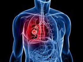 Giải đáp: Ung thư phổi có nguy hiểm không?